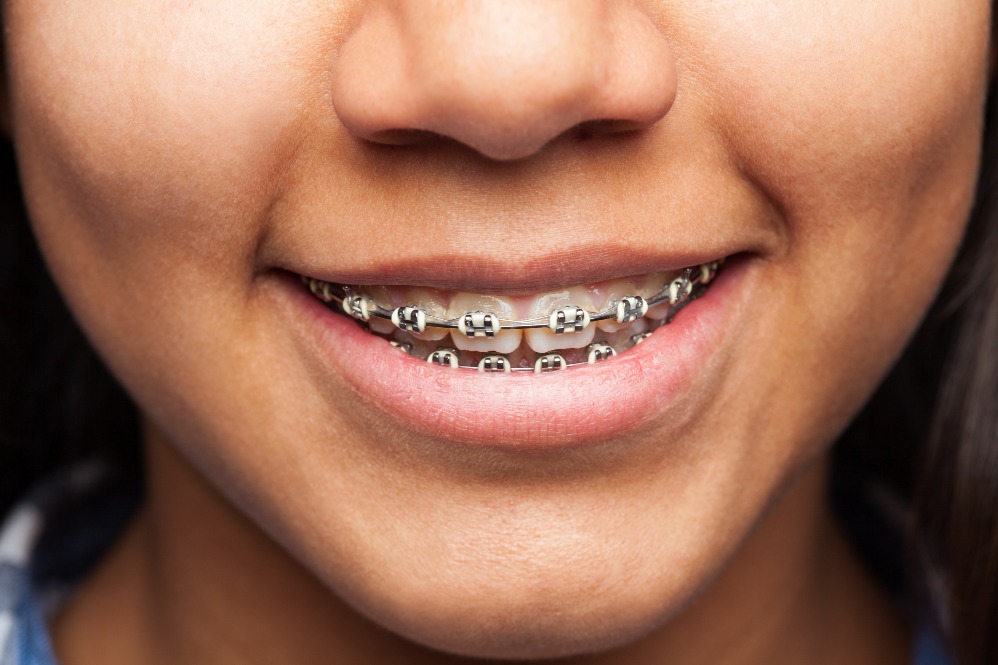 Orthodontic Treatment in Delhi – Customised Pla... main image