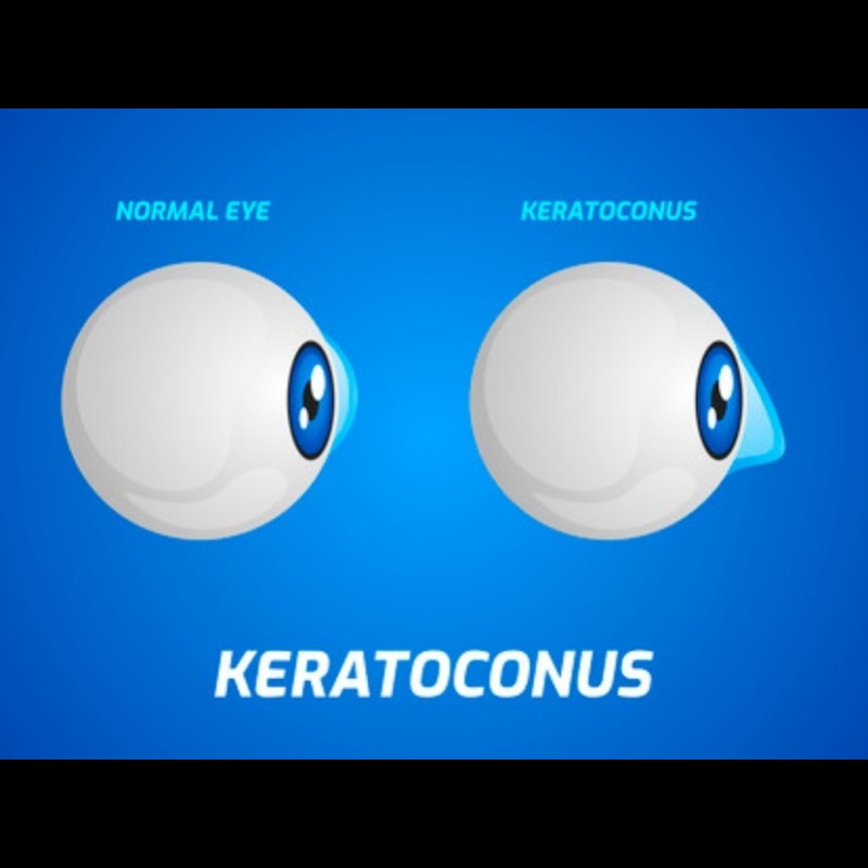 Keratoconus Treatment in Nagpur – Strengthen Your ... main image