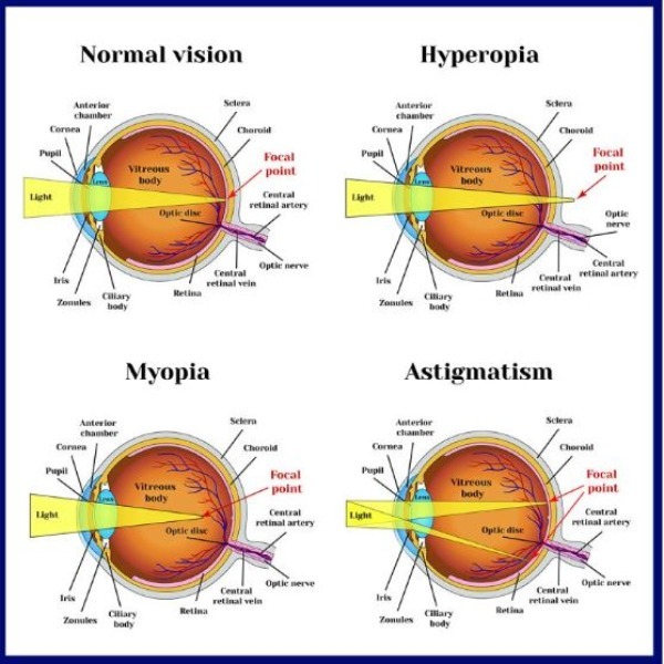 Refractive Error Solutions in Nagpur – See Clea... main image