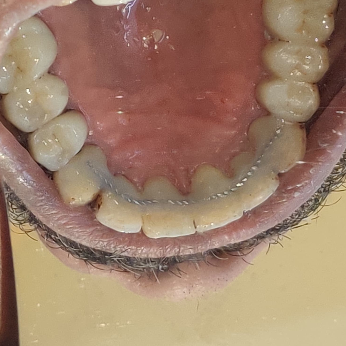 Loose teeth treatment in Mira Road Dentist to f... main image