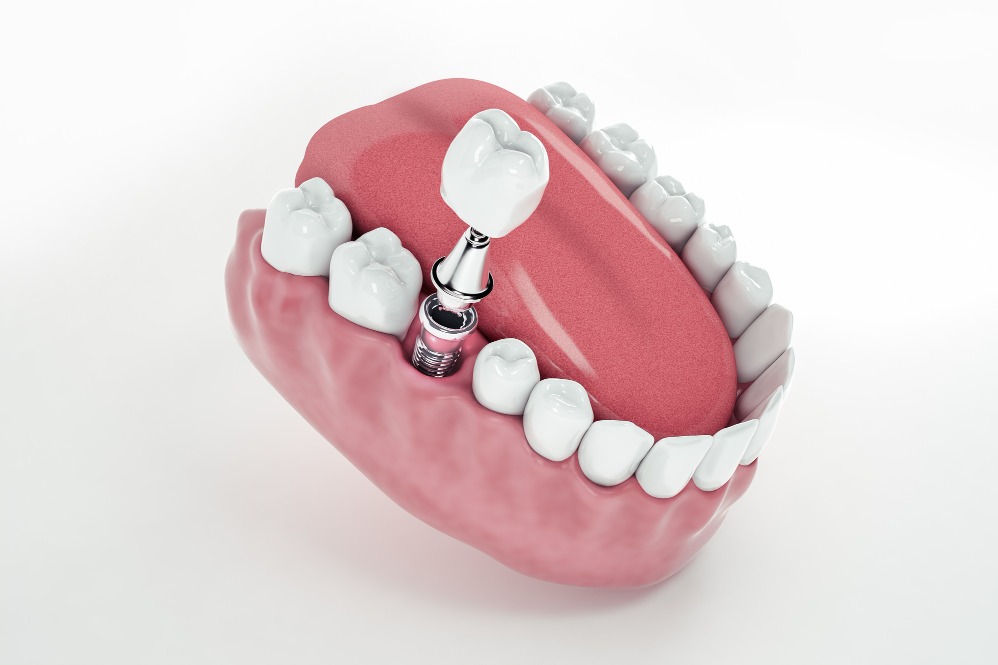 Dental Implants in Delhi for Missing Teeth Repl... main image