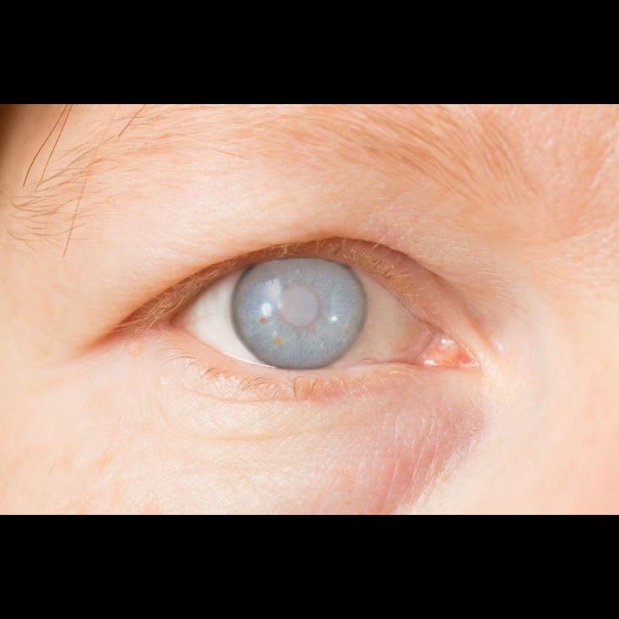 Cataract Surgery in Nagpur – Regain Clear Visio... main image