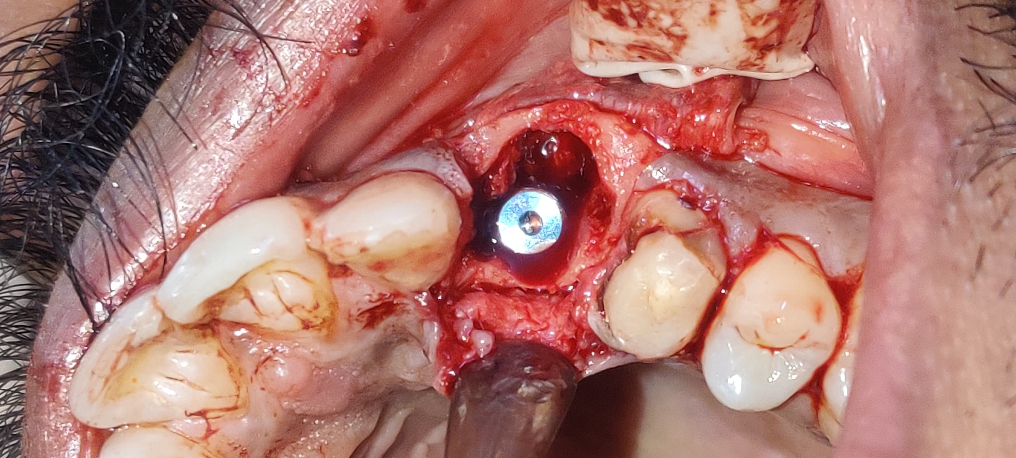 Implant doctors in Mira Road East Affordable Im... main image