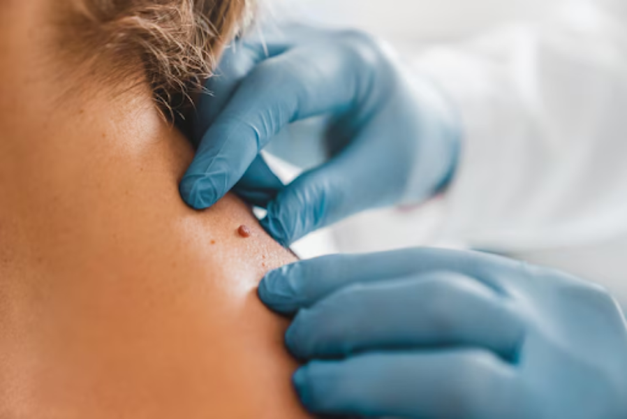 Skin Tag Removal in Delhi – Safe and Scar-Free Res... main image