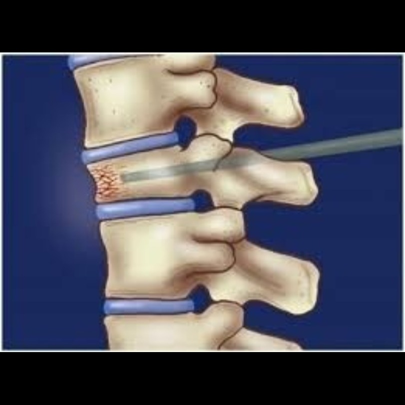 Vertebroplasty Treatment in Nagpur – Quick Reli... main image