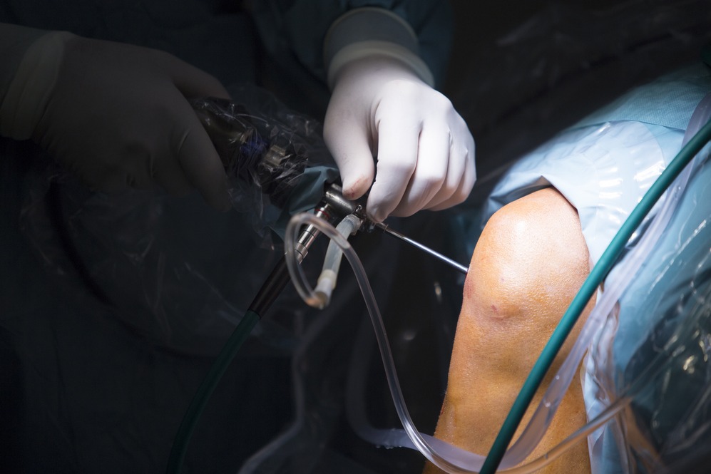 Knee Arthroscopy in Nagpur – Minimally Invasive... main image