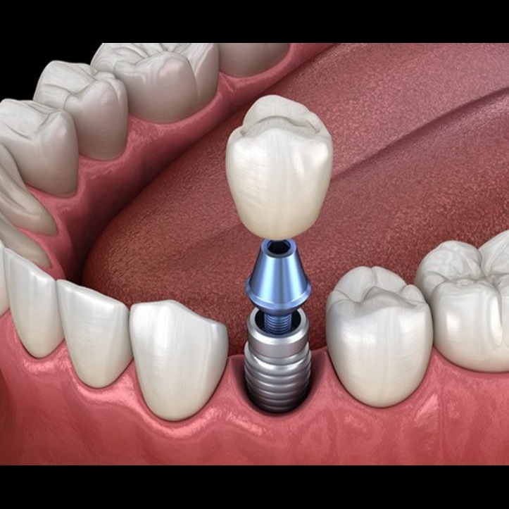Dental Implants in Rajouri Garden ﻿ At Sobti's ... main image