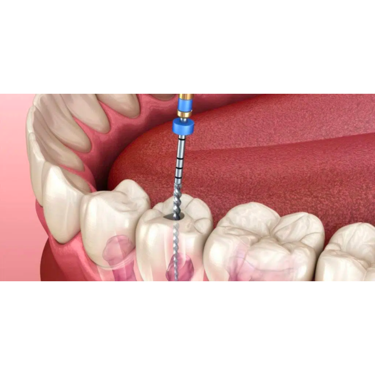 RCT Treatment in Rajouri Garden When tooth pain... main image