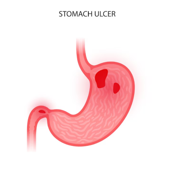 Ayurvedic Medicine for Ulcer in Pune – Heal You... main image