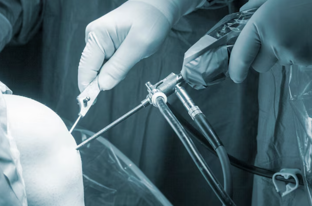 Keyhole Surgery in Chennai – Precise, Painless, an... main image