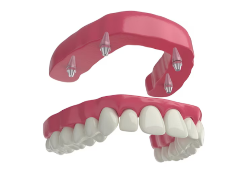 Full Mouth Implants in Delhi for Complete Denta... main image