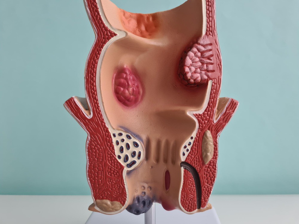 Piles Treatment in Velachery – Effective Relief... main image