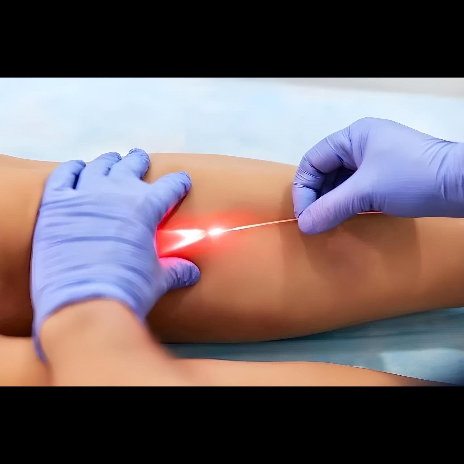 Laser Varicose Veins Treatment in Dombivli – Safe ... main image