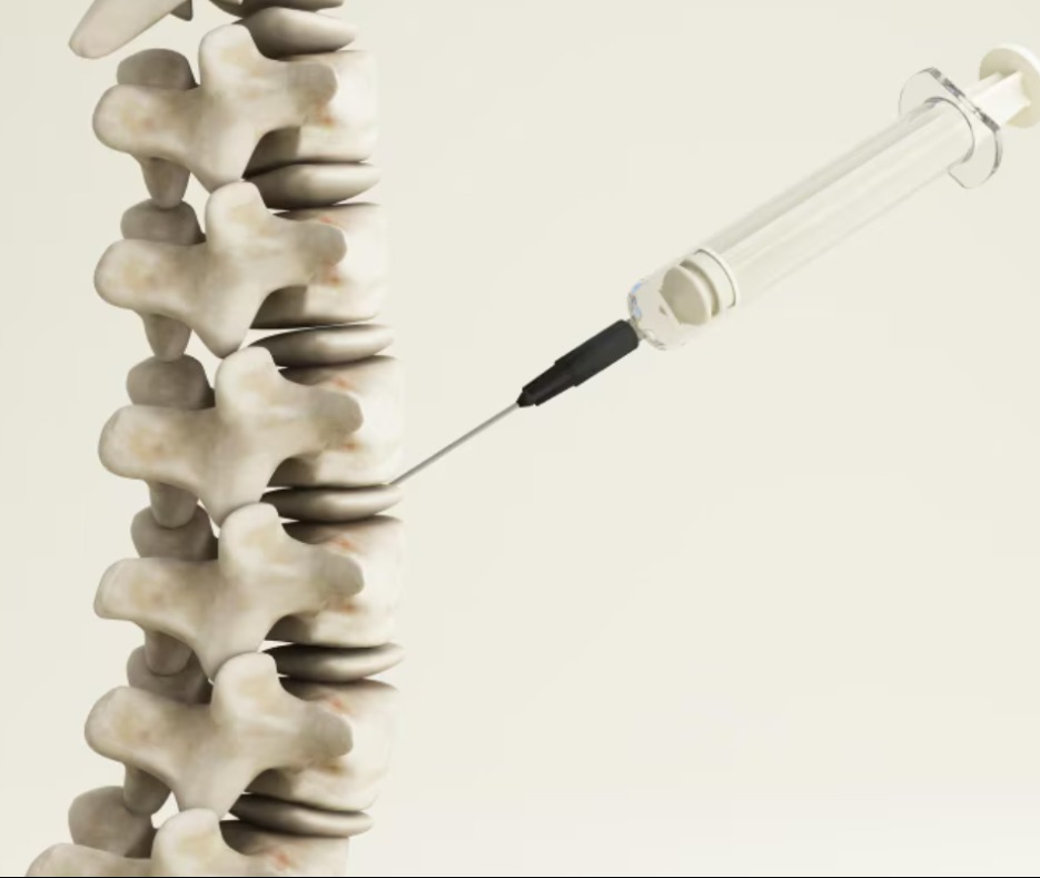 Kyphoplasty Procedure in Nagpur – Restoring Spi... main image