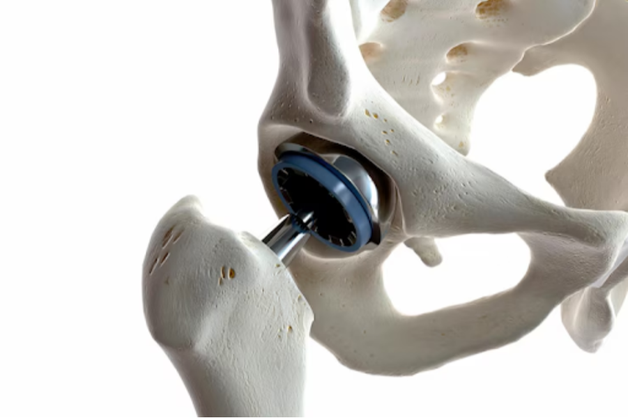 Hip Replacement Surgery in Ravet – Restoring Mo... main image
