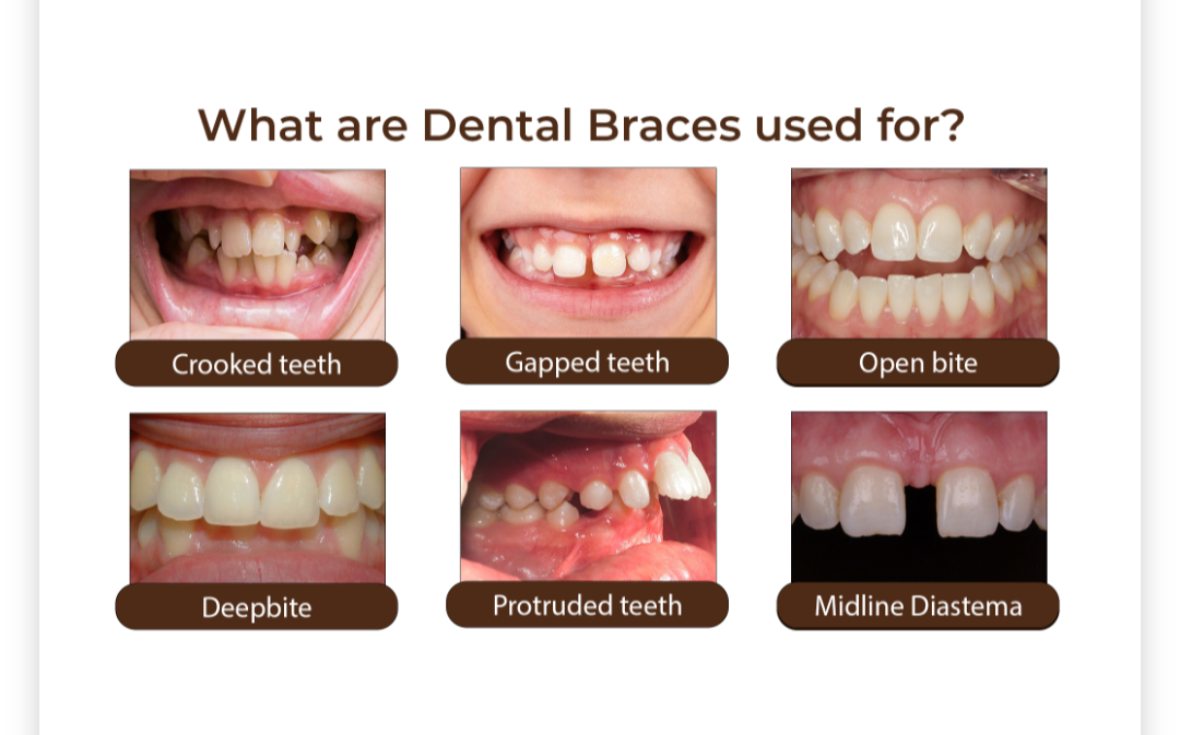 BEST DENTAL BRACES TREATMENT IN PATHARDI PHATA . W... main image