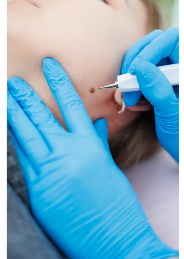 Wart Removal in Delhi – Quick and Painless Solutio... main image