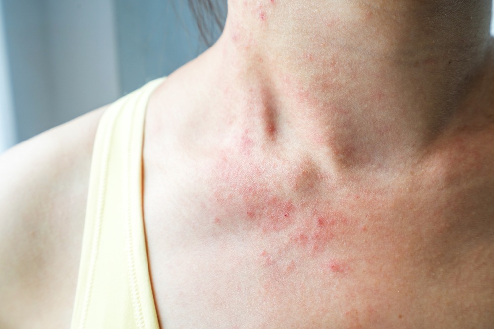 Ayurvedic Treatment for Skin Diseases in Pune –... main image
