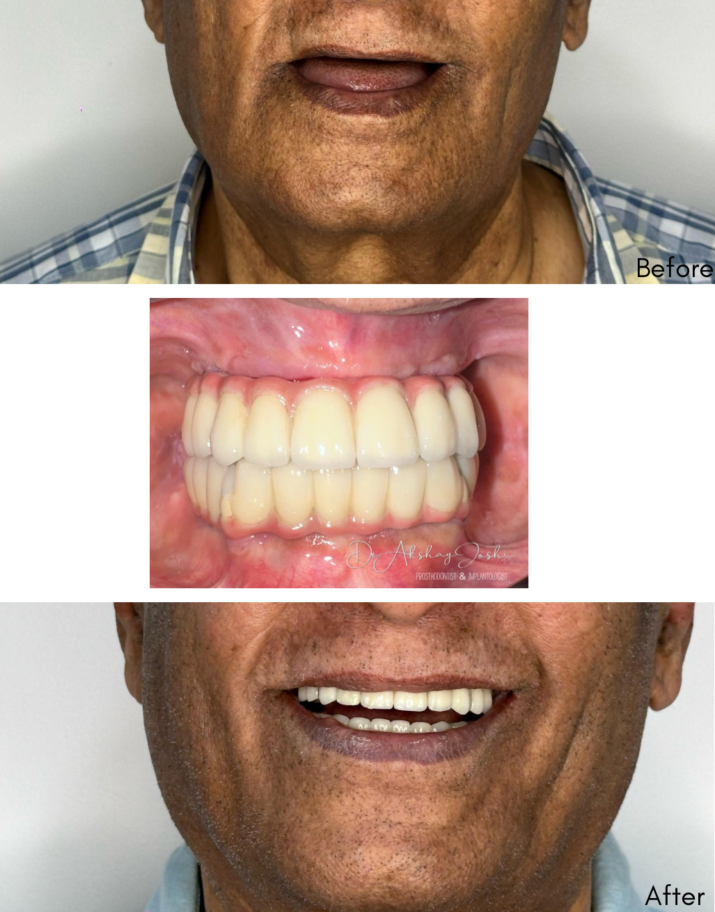 Dental Implants. One step solution for fixed te... main image