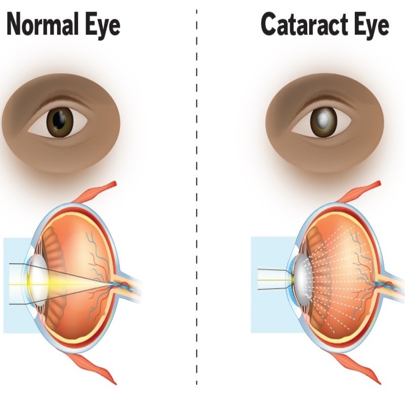 Best Cataract Surgery Options in Nagpur – Regai... main image