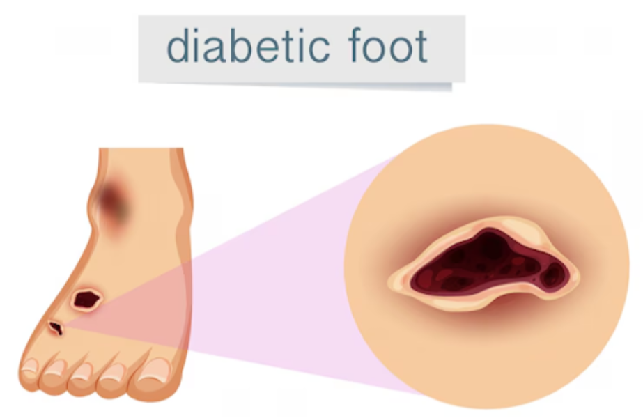 Diabetic Wound Treatment In Bangalore With Advance... main image