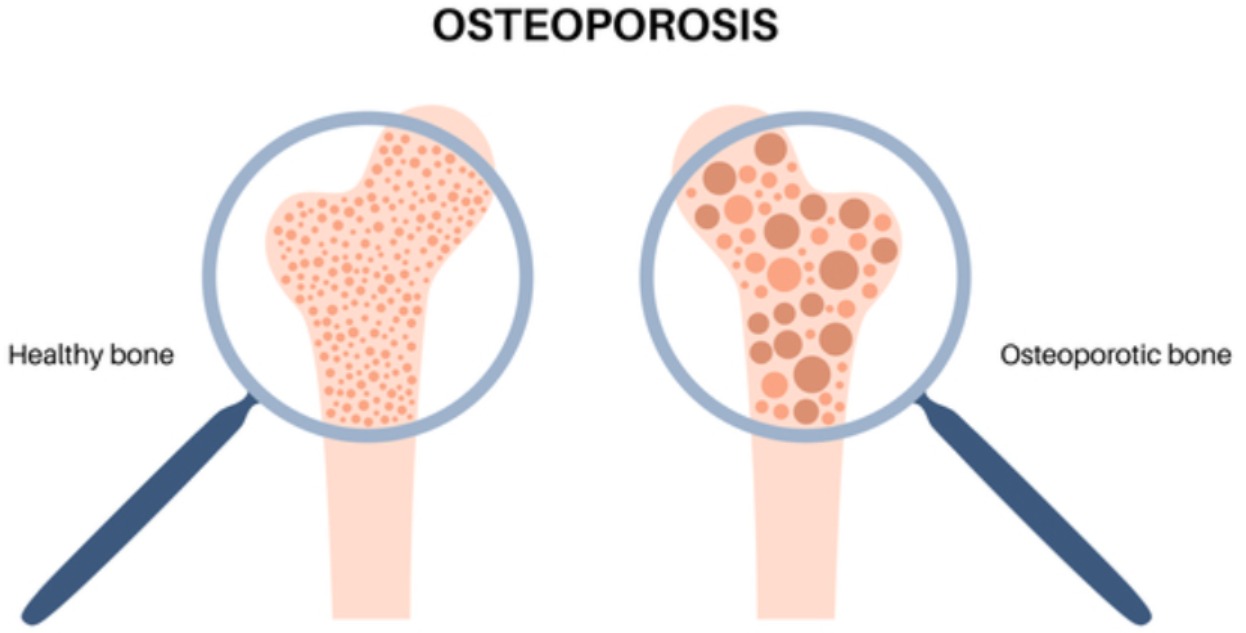 Osteoporosis Management in Nagpur – Prevent Fra... main image