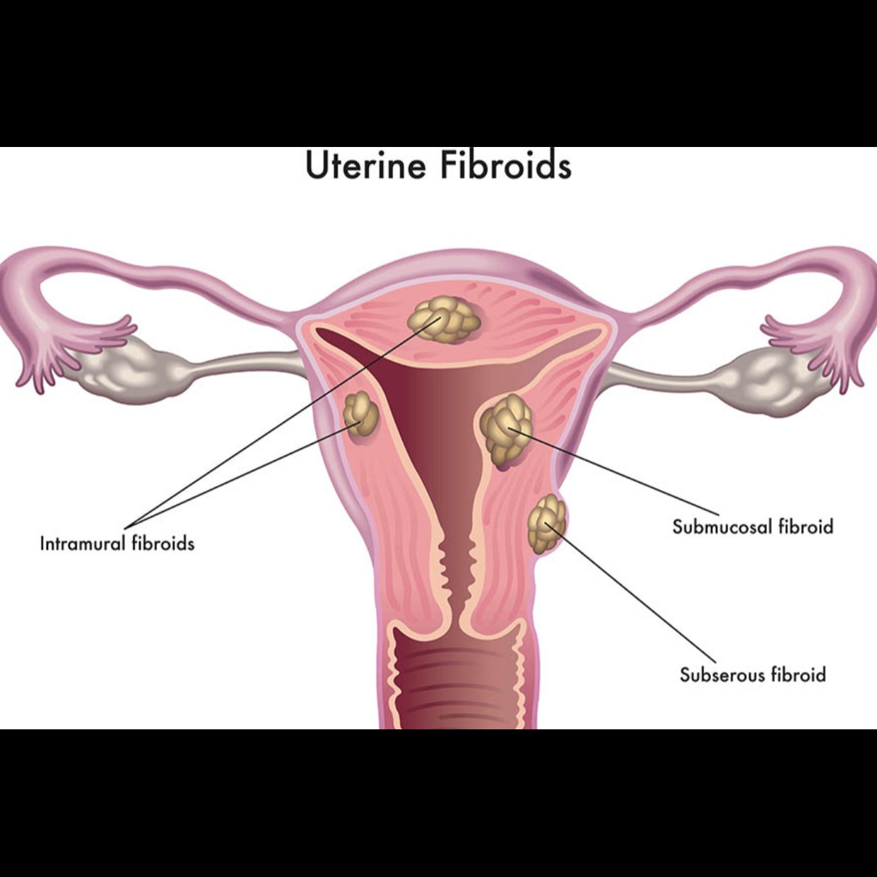 Fibroid Uterus Treatment in Nagpur – Relief wit... main image