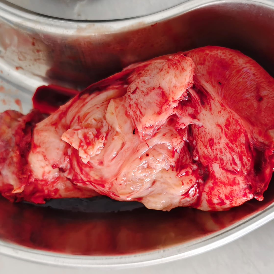 Hysterectomy is the surgical removal of the ute... main image