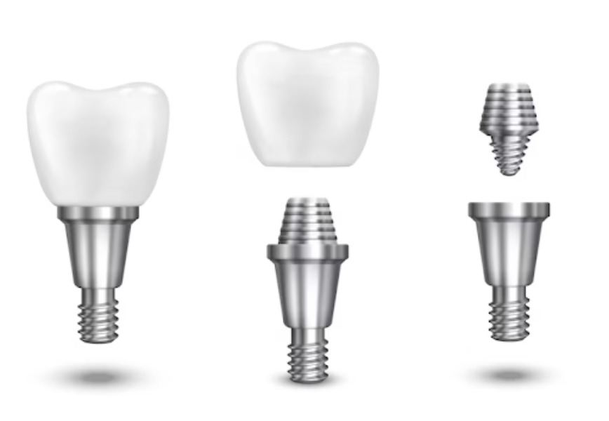 Basal Dental Implants in Delhi for Weak Bone Suppo... main image