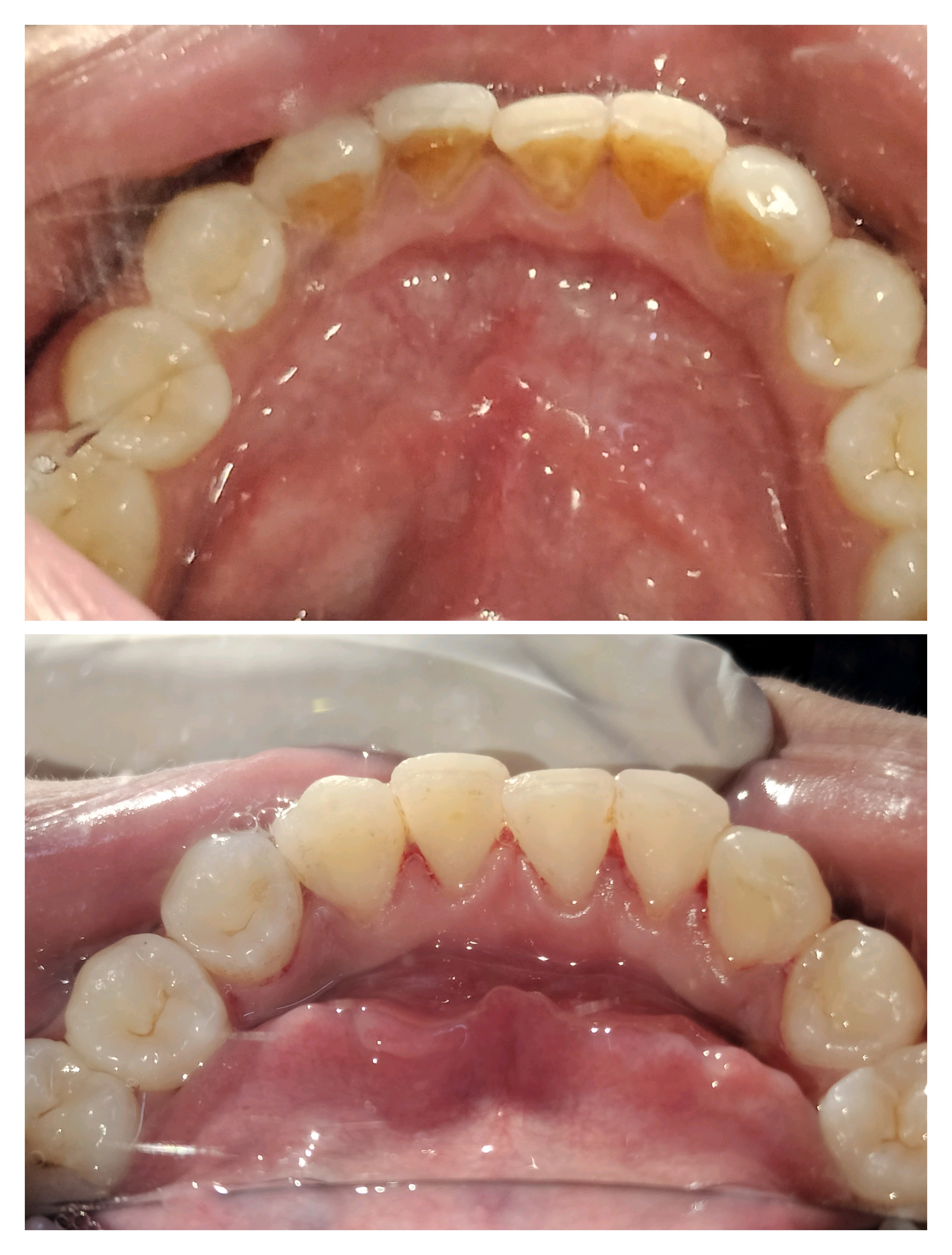Teeth cleaning in Mira Road Teeth cleaning near... main image