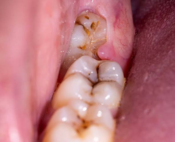 Emergency wisdom teeth removal clinic Best dent... main image