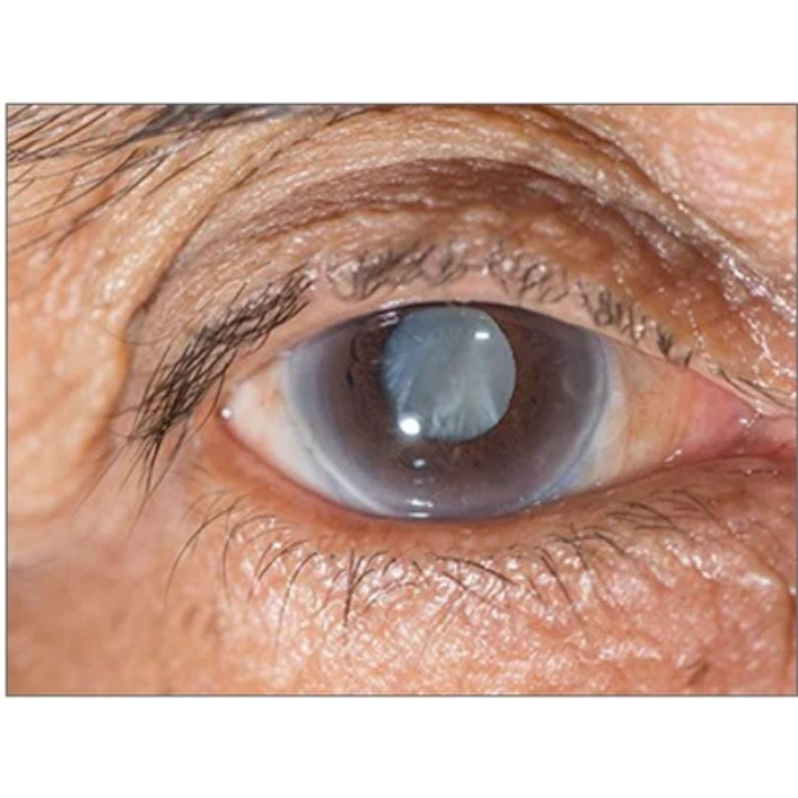 No Injection Cataract Surgery in Nagpur – A Pai... main image