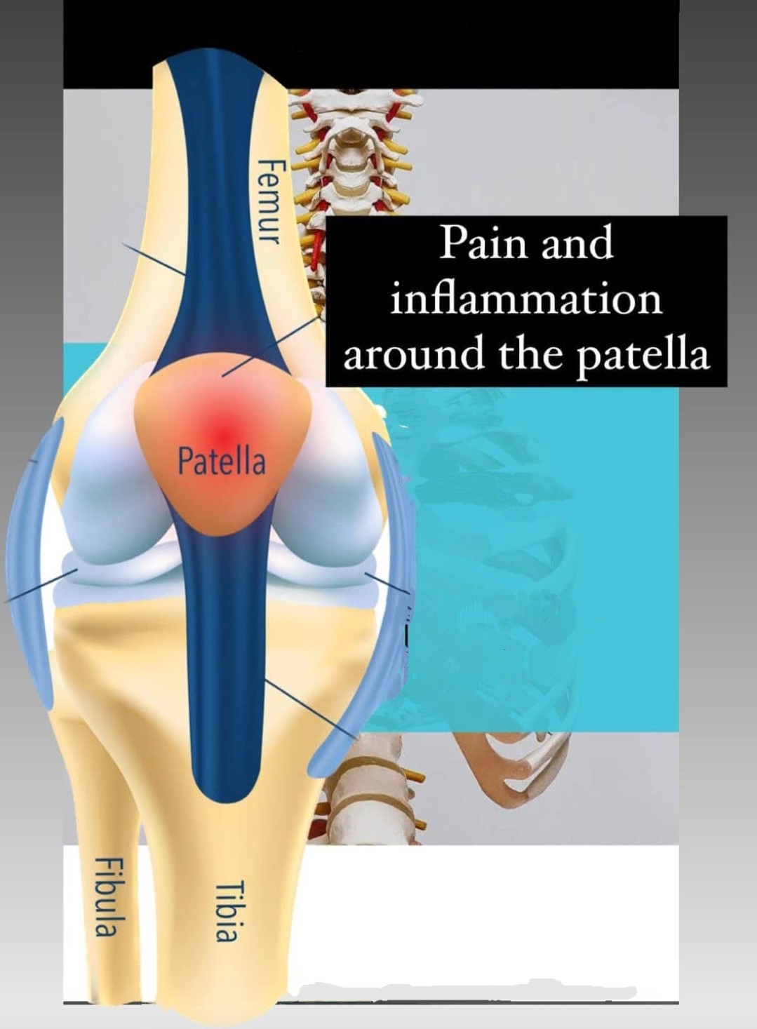 Patellofemoral pain syndrome (PFPS), also known as... main image