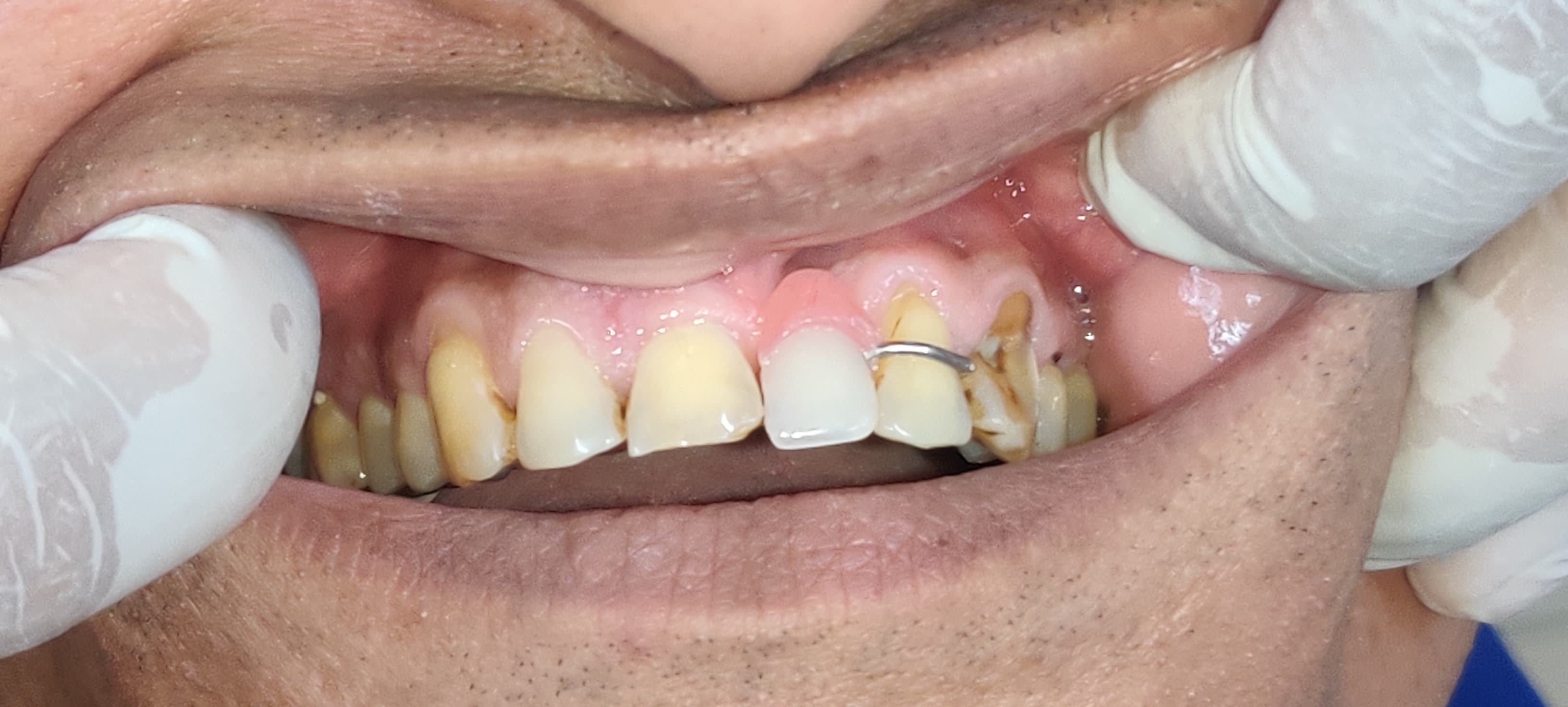 Single teeth denture in Mira Road Dental clinic... main image