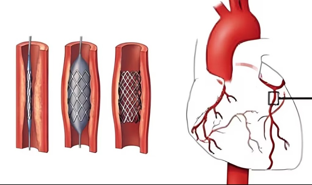 Completion Angiography in Nagpur – Accurate Post-S... main image