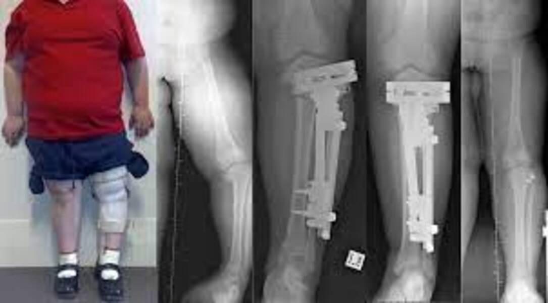 Deformity Correction in Pune – Specialized Orth... main image