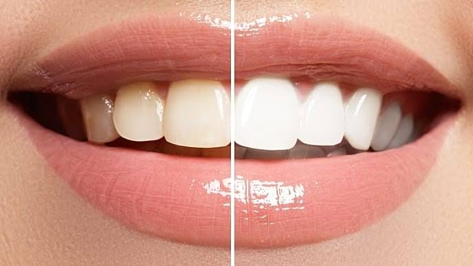 Teeth whitening in Mira Road Teeth whitening near ... main image