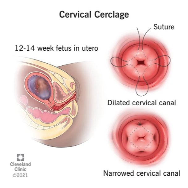 Cervical Cerclage Procedure in Nagpur – Preventing... main image
