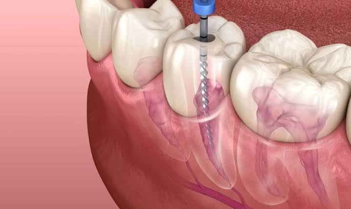Root Canal Treatment for Lasting Relief in Mira... main image