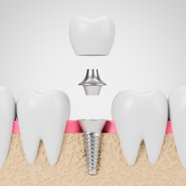 Basal Implants in Delhi for Faster and Stronger... main image