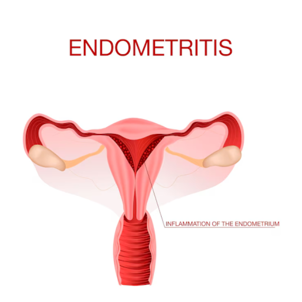 Endometriosis Treatment Options in Pune – Preci... main image