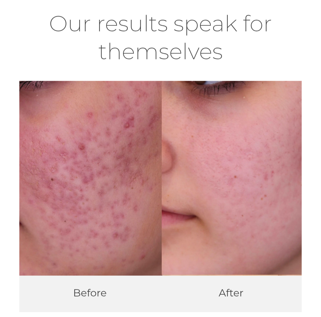 BEST ACNE SCAR TREATMENT IN NASHIK. We offer be... main image