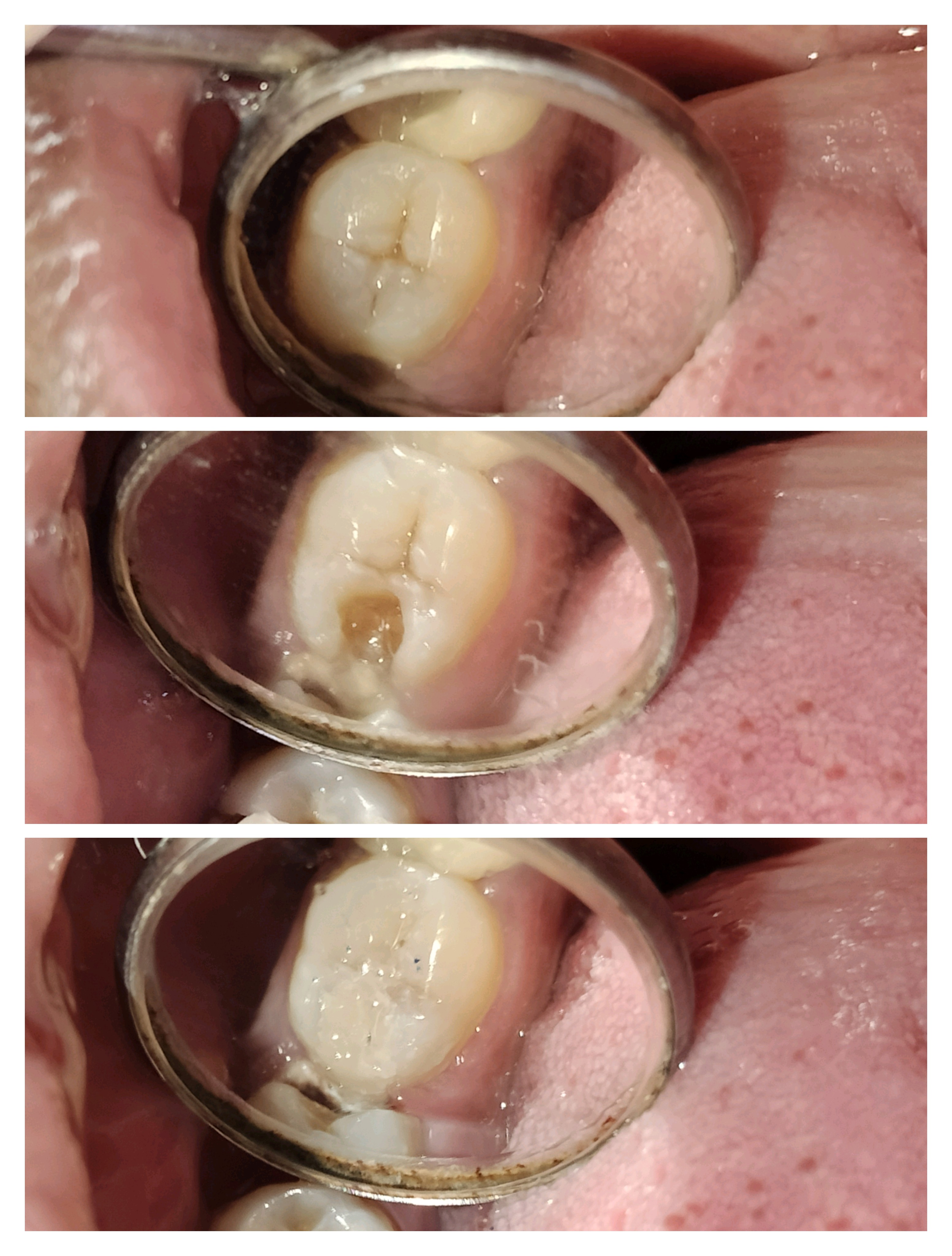 Cosmetic dentist near me Tooth filling in Mira ... main image