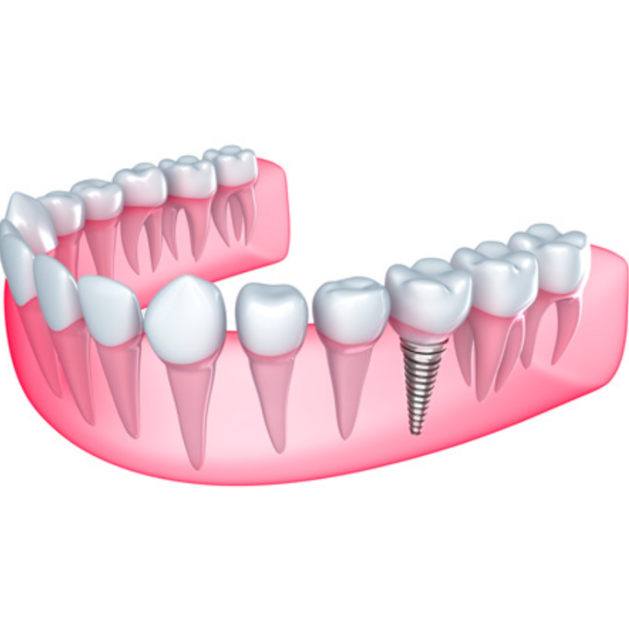 Dental Implant Clinic in Mahavir Enclave – Rest... main image