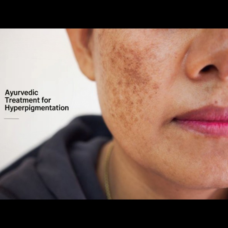Ayurvedic Treatment for Hyperpigmentation in Pune ... main image