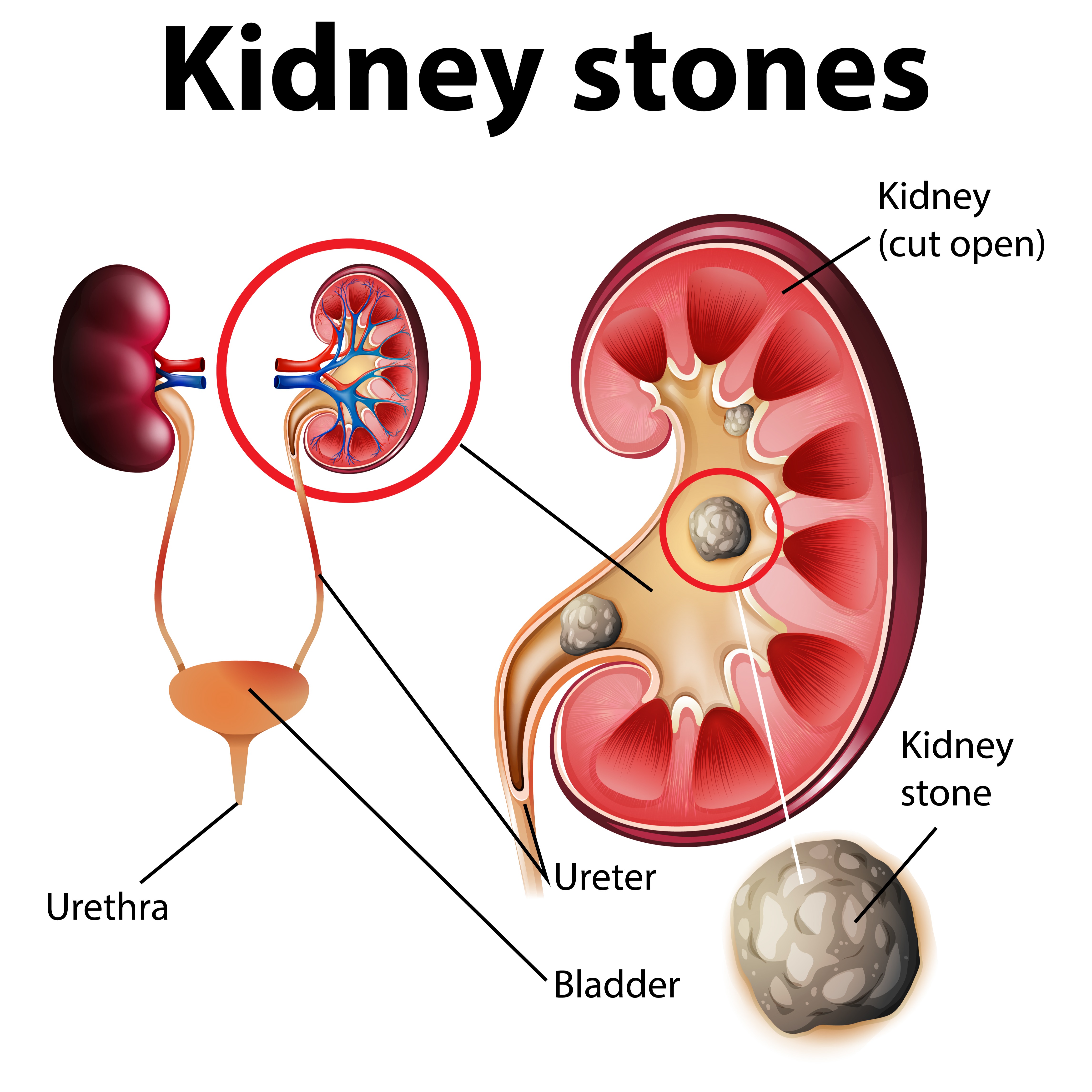 Kidney Stone Treatment in Nagpur with Pain Mana... main image