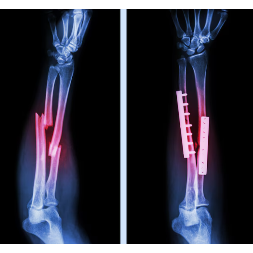 Bone Fracture Treatment in Chennai: Precision Heal... main image