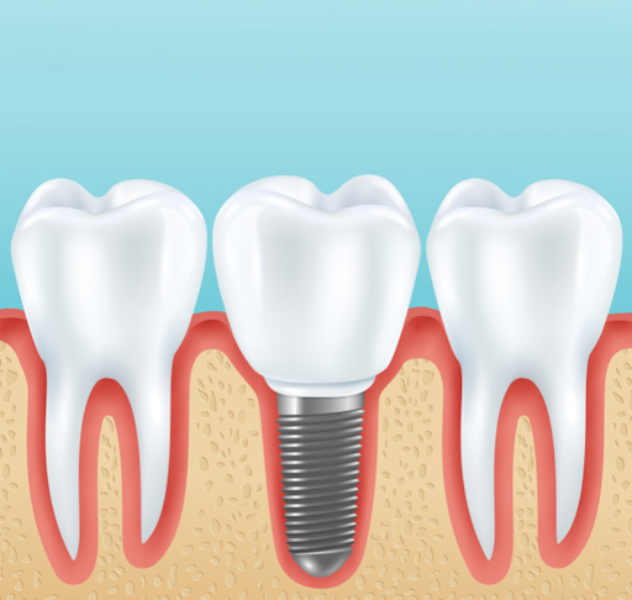 Conventional Implants in Delhi for Permanent To... main image