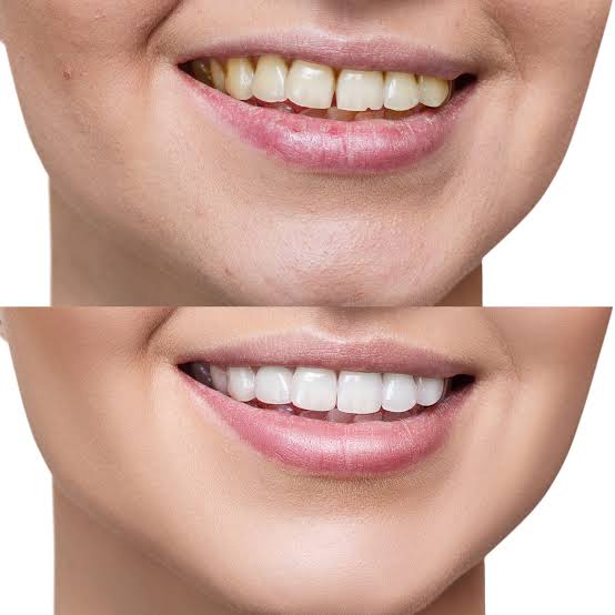 Teeth space correction in Mira Road Have spaces... main image
