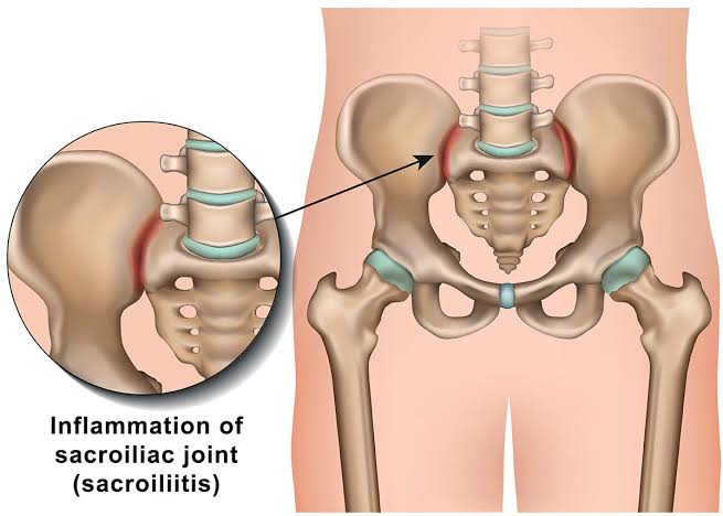 🔈 SACROILIITIS - CAUSES, SYMPTOMS, TREATMENT 🔎 Wha... main image
